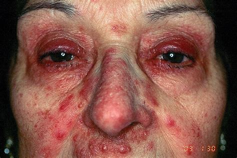 eczema on eyelid - pictures, photos