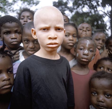 African albino boy. Albinoism is often demonized in Africa, with many being killed in order to ...