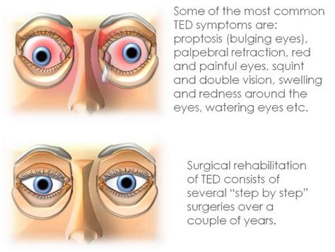 Eyelid surgery for TED