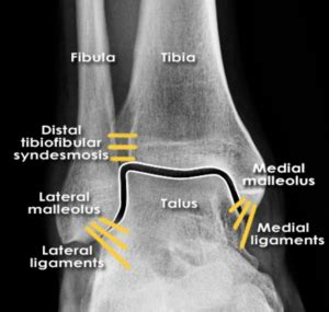 Ankle x-ray interpretation – Don't Forget the Bubbles