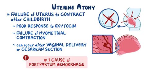 Uterine atony: Clinical sciences - Biblioteca de Osmosis