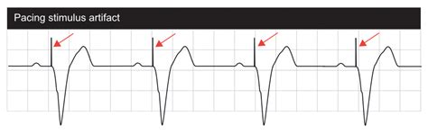 Interpretation of Pacemaker ECG – Cardiovascular Education