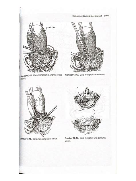 Histerektomi Obstetrik Dan Histerorafi 103 | PDF