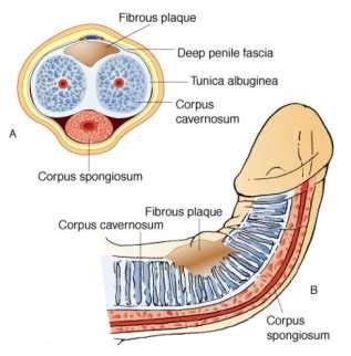 Peyronie’s disease: frequently asked questions | CUH