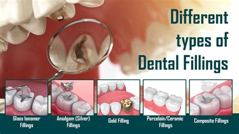 What are the Different Types of Dental Fillings? | My Gentle Dentist