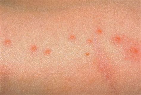 gnats bites on humans | gnat bites on humans >>> | Bed bugs bites skin, Bed bug bites, Itchy red ...