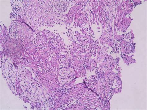 Fibrous histiocytoma of bone – Histopathology.guru