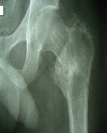 Removal of external fixator at 4 months postoperatively illustrating... | Download Scientific ...