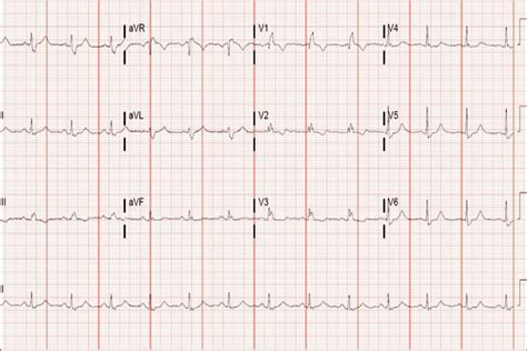 A 42-Year-Old Male with an Abnormal ECG - Page 2 of 2 - Journal of Urgent Care Medicine