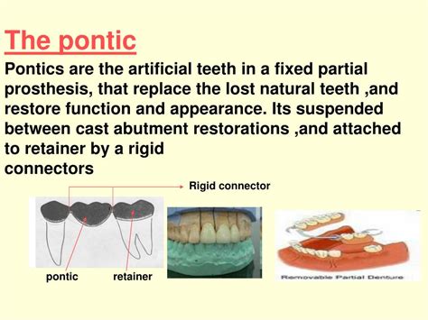 PPT - PONTIC DESIGN By DR. MUSTAFA I. ELGHOUL B.SC,B.D.S,MS(ORTHO) PowerPoint Presentation - ID ...