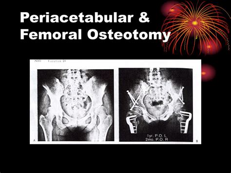 PPT - Hip Biomechanics and Osteotomies PowerPoint Presentation - ID:487945