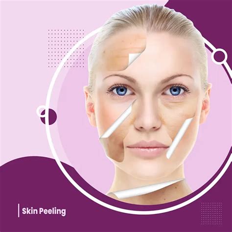 Chemical Peel Treatment for Skin - Skin Peeling Treatment in Surat