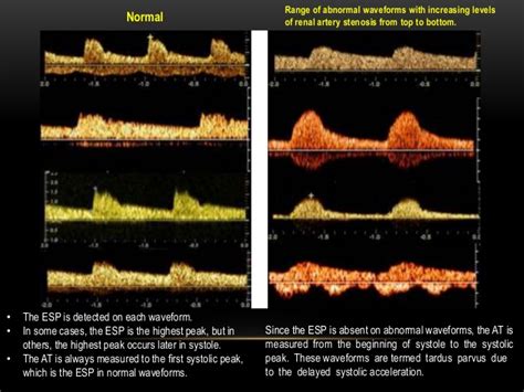 Renal Artery Doppler – Sonographic Tendencies