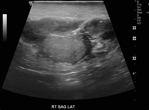 Epididymo-orchitis | Image | Radiopaedia.org