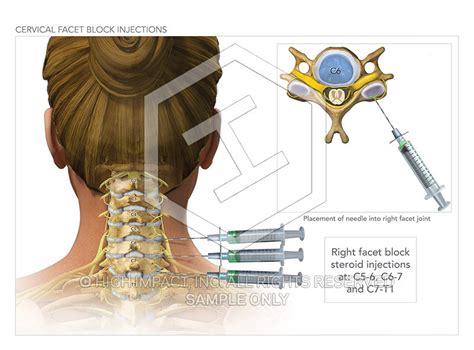 Image 09830_im02: Cervical Facet Block Injections Illustration