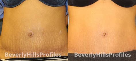 Stretch Mark Removal, Before & After Photos | Los Angeles