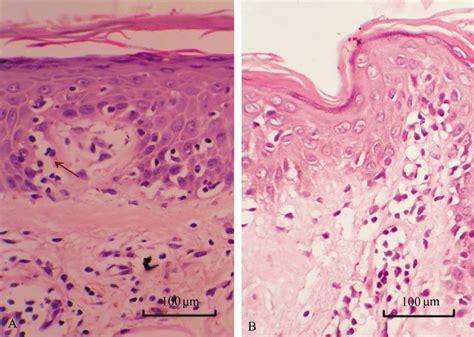 Histopathologic changes of a skin lesion of suspected early mycosis... | Download Scientific Diagram