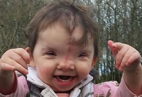 Doctors Did an Amazing Thing to Give This Disabled Baby a New Face | LifeNews.com