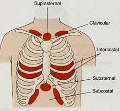 Location of Retractions | figure 14 13 location of retractions ...