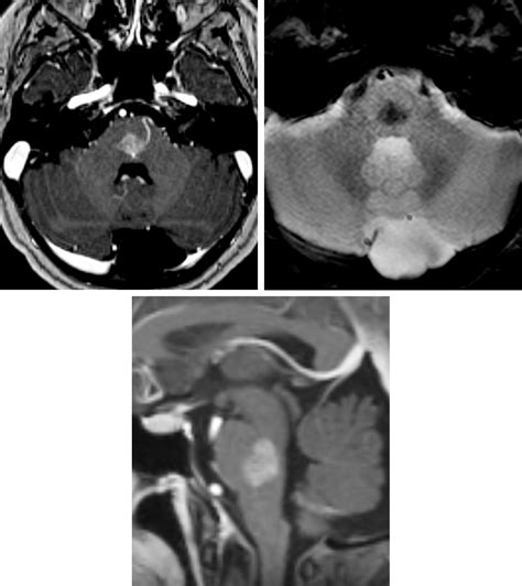 Capillary Telangiectasia | The Neurosurgical Atlas