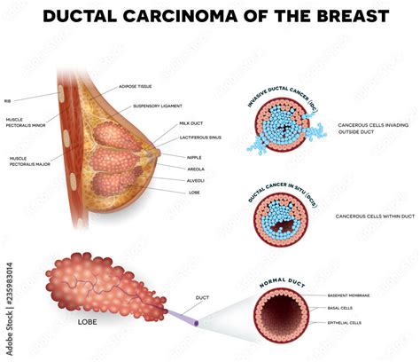 Ductal carcinoma of the breast, detailed medical illustration. Ductal cancer in situ and ...