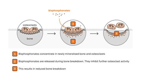 Ask the Nurse: Bisphosphonates - Myeloma UK