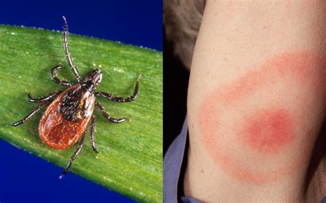 Next generation Lyme disease tests found efficacious and ready for clinical arena | Cold Spring ...