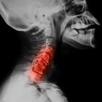 Cervical Spine Osteoarthritis: Symptoms & Prevention - Innovative Physical Therapy