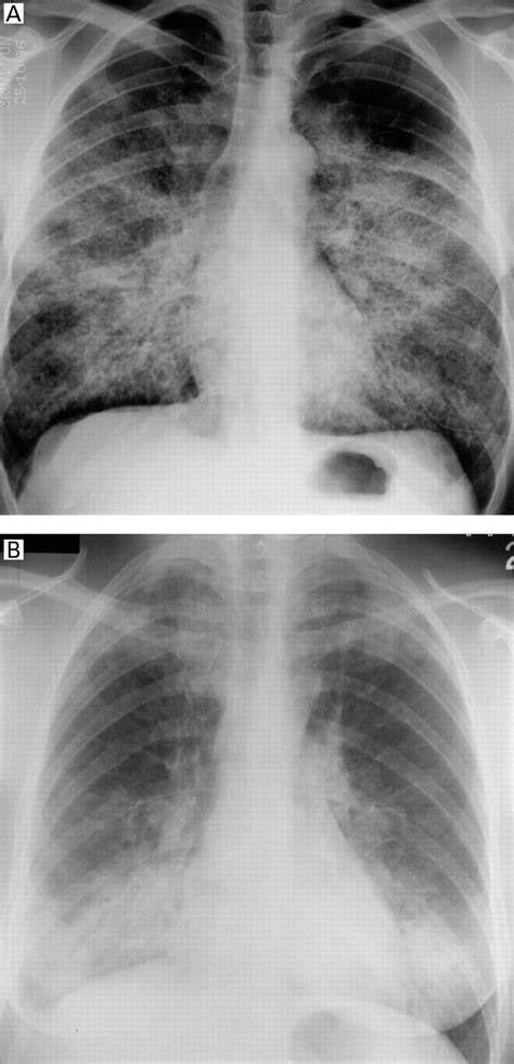 Pulmonary alveolar proteinosis: clinical aspects and current concepts ...