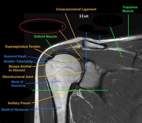 shoulder coronal oblique MRI 5 Diagram | Quizlet