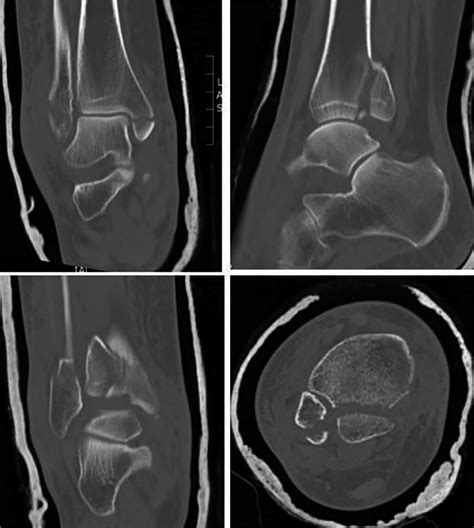 Trimalleolar fracture with computed tomography scan revealing details ...