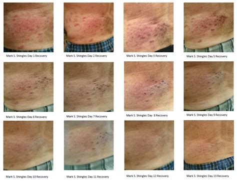 Review - Shingles - Mark S - NeoGenesis Pro