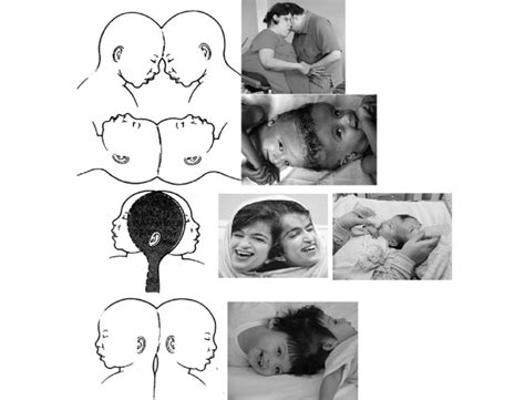 Left: Drawings showing 4 general subclassifications among craniopagus... | Download Scientific ...