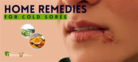 10 Simple and Best Home Remedies for Cold Sores