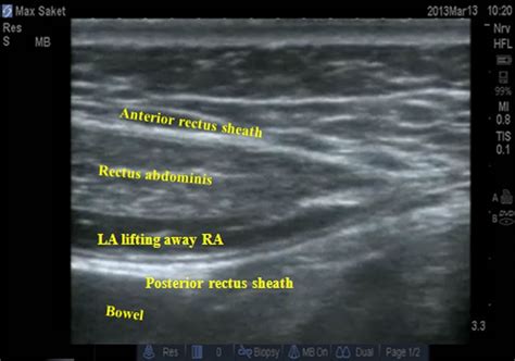 Rectus Sheath Block