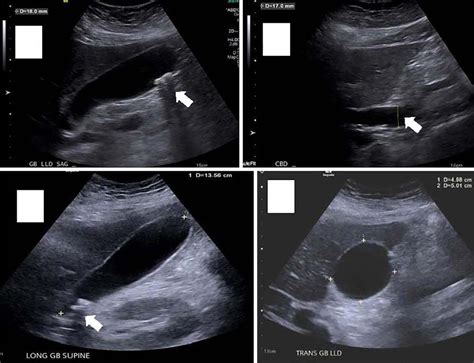 Gallstone Ultrasound