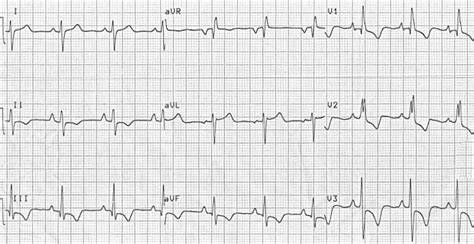 Right Ventricular Hypertrophy (RVH) • LITFL • ECG Library Diagnosis