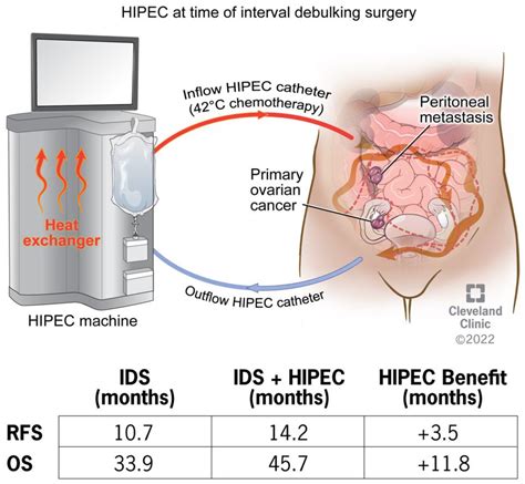 HIPEC: Hyperthermic Intraperitoneal Chemotherapy UChicago, 41% OFF