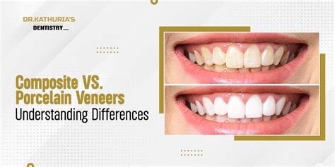 Composite vs. Porcelain Veneers: Understanding Differences