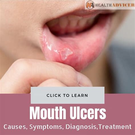 Mouth Ulcers: Causes, Picture, Symptoms, Diagnosis And Treatment