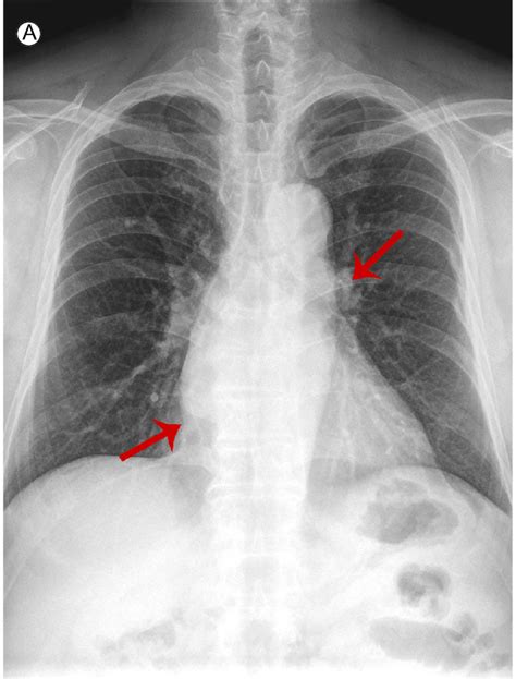 (A) Initial chest radiograph showing double contours in the right... | Download Scientific Diagram