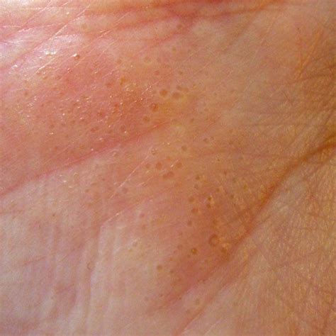 Hand Eczema or Dyshidrosis. This is a picture of my hand when I have a ...