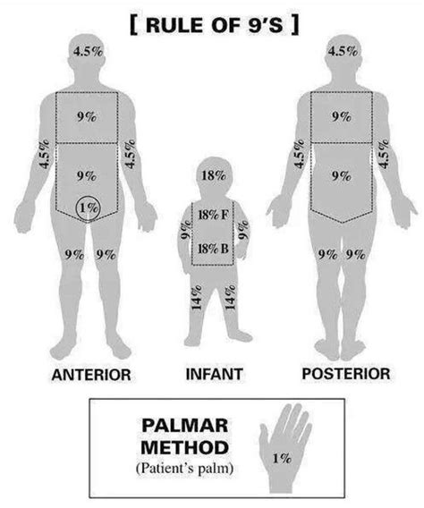 Rule of 9 and Palmer Method - MEDizzy