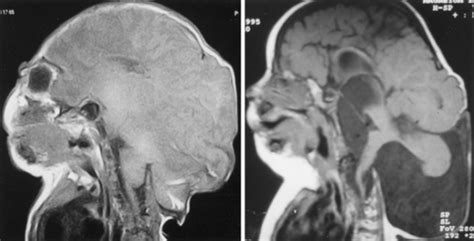 Iniencephaly: neuroradiological and surgical features in: Journal of ...