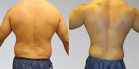 Before & After Chest Liposuction | Sono Bello Results