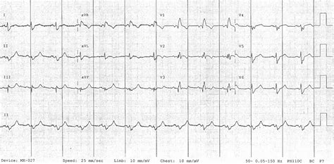 OMI: Replacing the STEMI misnomer • LITFL • ECG Library