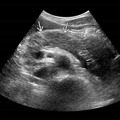 Pancreatic Abscess Ultrasound