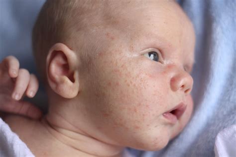 Baby Acne in Newborns: Symptoms, Causes, and Treatment