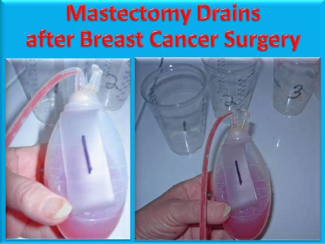 Video Tutorial: How to Empty Mastectomy Drain Bottles After Breast ...