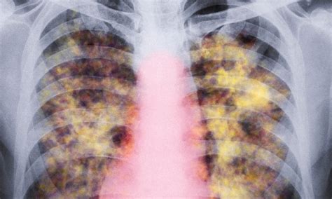 The international standard in dust disease reporting. | I-MED Radiology Network